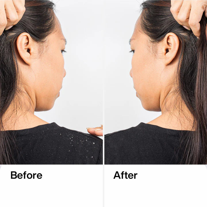 GKHair - Anti Dandruff Shampoo 8.5 Oz - Limolin 