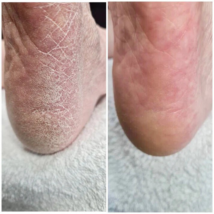 LovaSkin Instant Foot Peel (30ml) Beauty & Personal Care