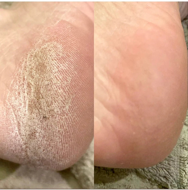 LovaSkin Instant Foot Peel (75ml) Beauty & Personal Care